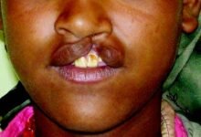 • Imagine friends shunning you just because you have cleft or lip palate