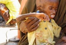 A malnourishedchild in Somalia