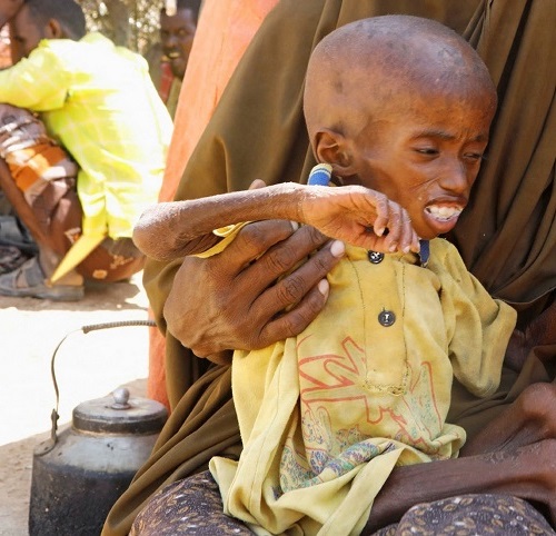 A malnourishedchild in Somalia